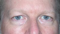Eyelid Lift Before & After Gallery - Patient 148101158 - Image 1