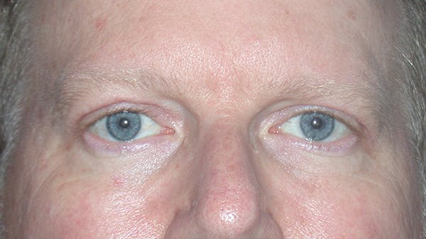 Eyelid Lift Gallery Before & After Gallery - Patient 148101158 - Image 2