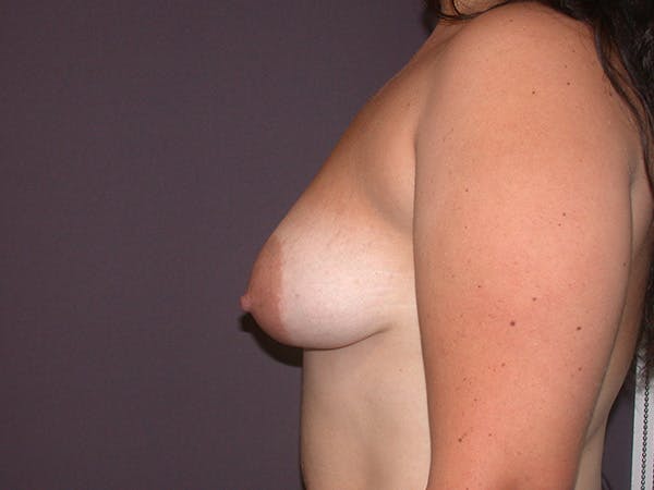 Tubular Breasts Gallery Before & After Gallery - Patient 456764 - Image 5