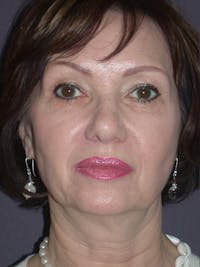 Facelift Gallery Before & After Gallery - Patient 757675 - Image 1