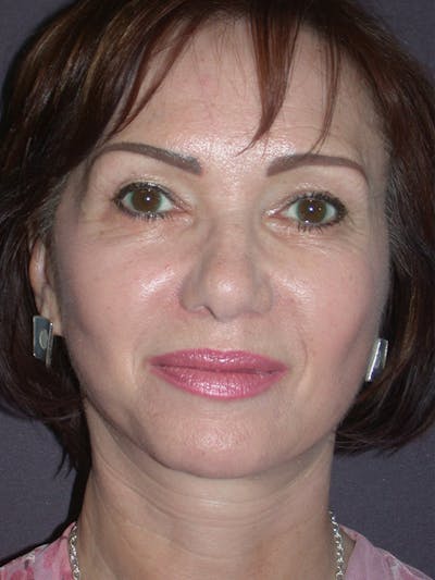 Facelift Gallery Before & After Gallery - Patient 757675 - Image 2
