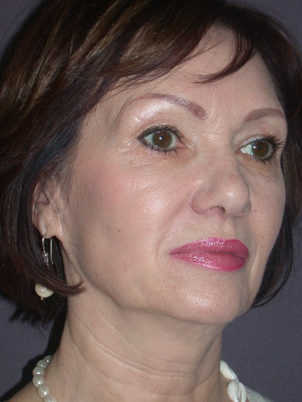 Facelift Gallery Before & After Gallery - Patient 757675 - Image 3