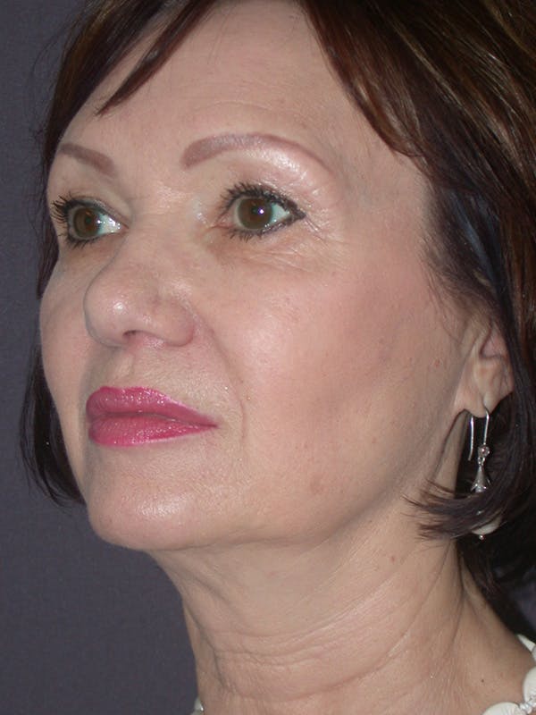 Facelift Gallery Before & After Gallery - Patient 757675 - Image 5