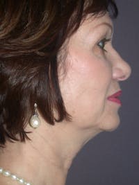 Neck Lift Gallery Before & After Gallery - Patient 327458 - Image 1