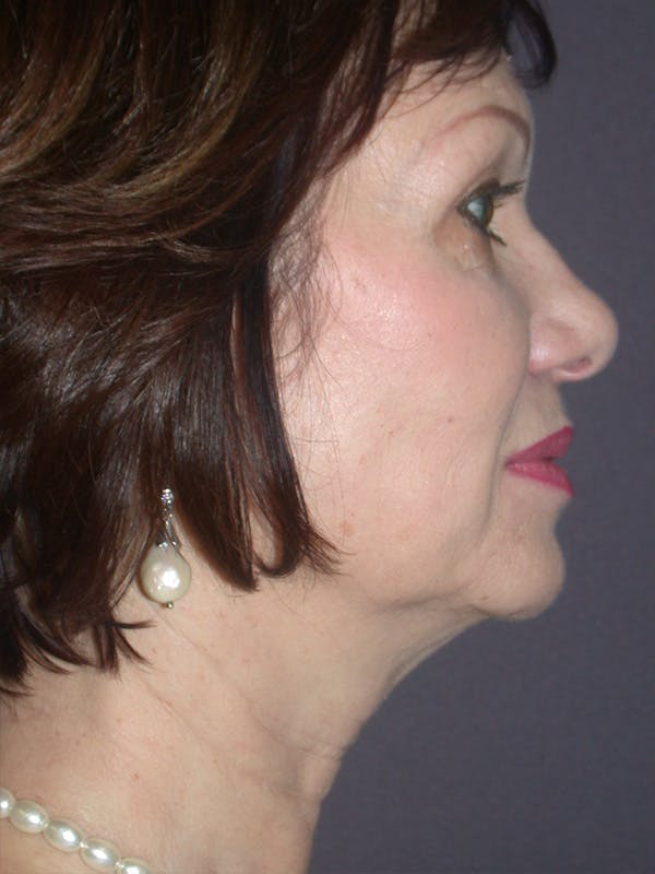Facelift Gallery Before & After Gallery - Patient 757675 - Image 7