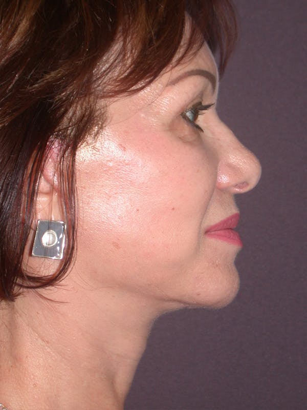 Facelift Gallery Before & After Gallery - Patient 757675 - Image 8