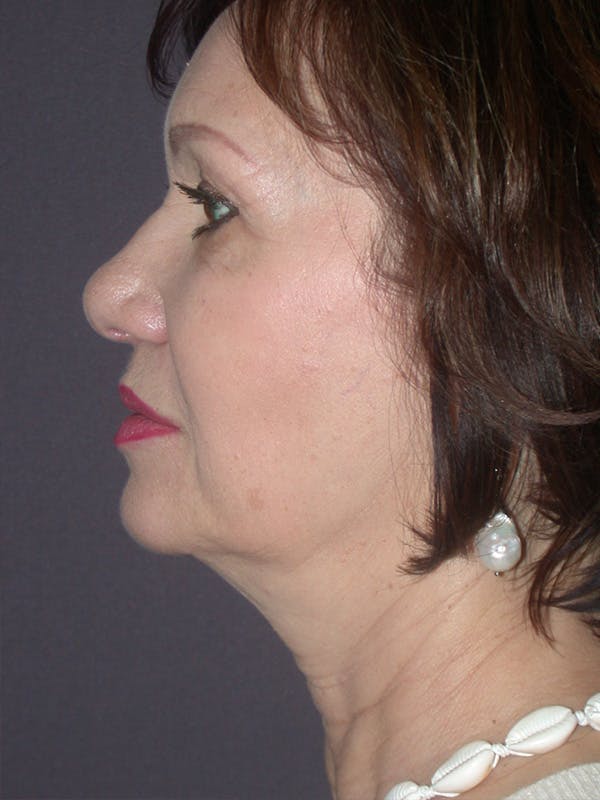 Facelift Gallery Before & After Gallery - Patient 757675 - Image 9
