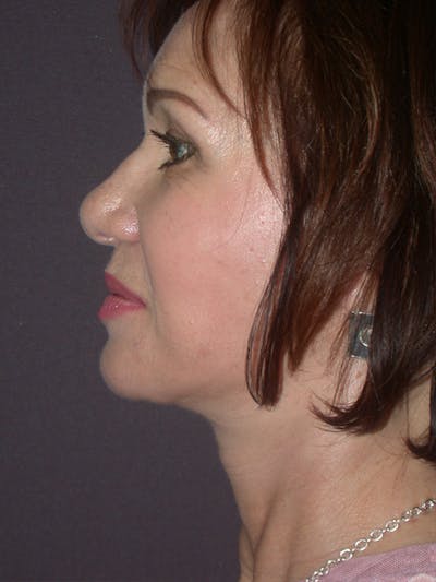 Facelift Gallery Before & After Gallery - Patient 757675 - Image 10