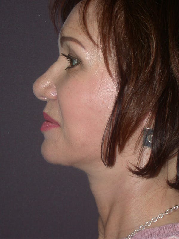 Facelift Gallery Before & After Gallery - Patient 757675 - Image 10