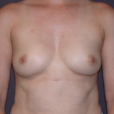 Breast Augmentation Gallery Before & After Gallery - Patient 122575 - Image 1