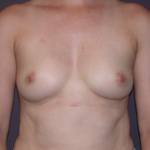 Breast Augmentation Gallery Before & After Gallery - Patient 122575 - Image 1