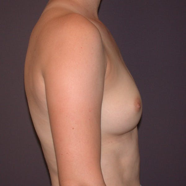 Breast Augmentation Gallery Before & After Gallery - Patient 122575 - Image 5