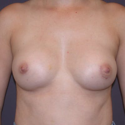 Breast Augmentation Gallery Before & After Gallery - Patient 122575 - Image 2