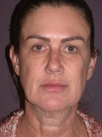 Facelift Gallery Before & After Gallery - Patient 347023 - Image 1