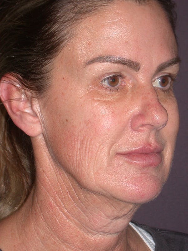 Facelift Gallery Before & After Gallery - Patient 347023 - Image 3