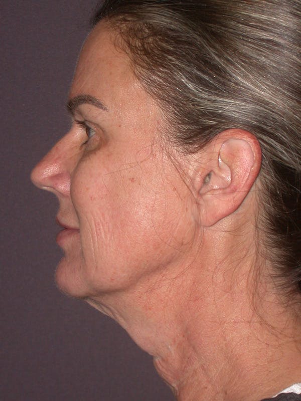 Facelift Gallery Before & After Gallery - Patient 347023 - Image 9