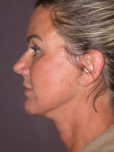 Facelift Gallery Before & After Gallery - Patient 347023 - Image 10
