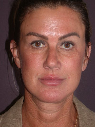 Facelift Gallery Before & After Gallery - Patient 347023 - Image 2