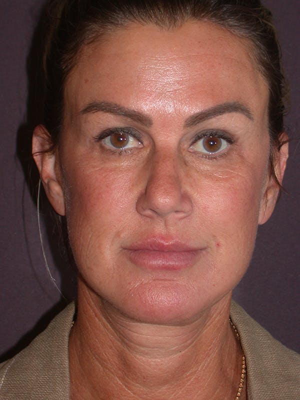 Facelift Gallery Before & After Gallery - Patient 347023 - Image 2