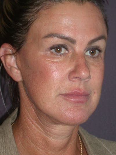 Facelift Gallery Before & After Gallery - Patient 347023 - Image 4