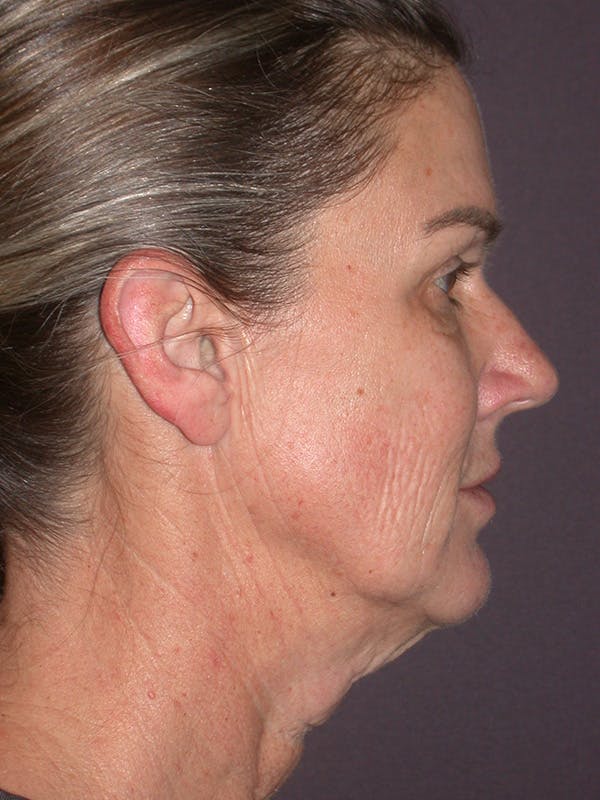 Facelift Gallery Before & After Gallery - Patient 347023 - Image 5