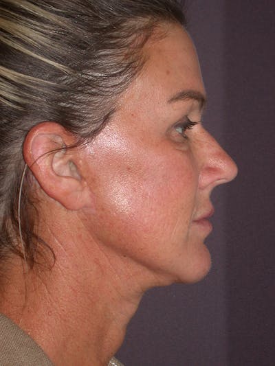 Facelift Gallery Before & After Gallery - Patient 347023 - Image 6