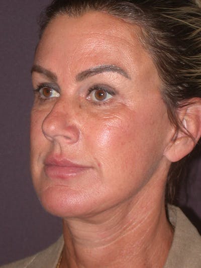 Facelift Gallery Before & After Gallery - Patient 347023 - Image 8