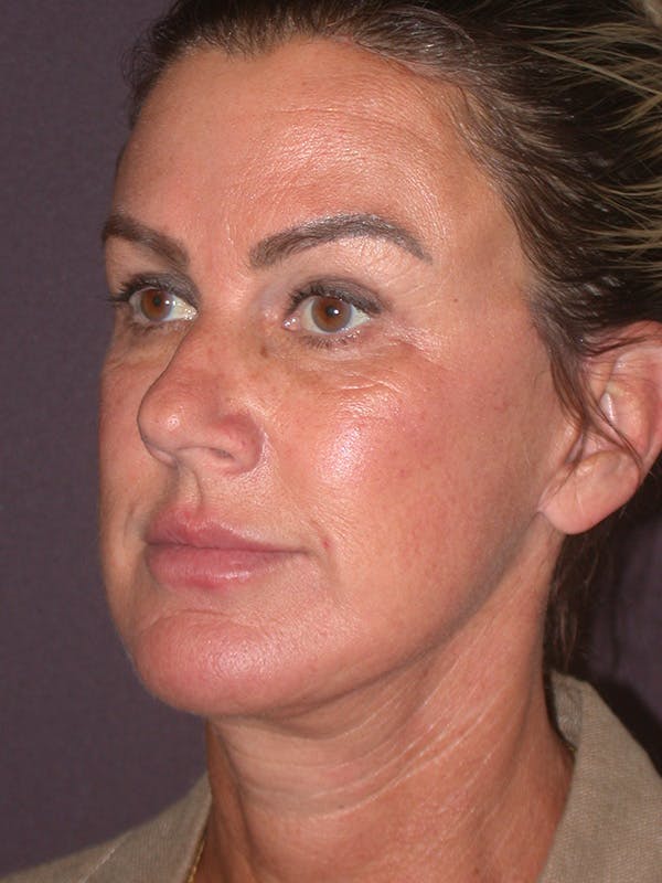 Facelift Gallery Before & After Gallery - Patient 347023 - Image 8