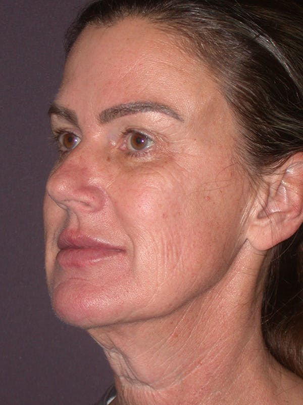 Facelift Gallery Before & After Gallery - Patient 347023 - Image 7