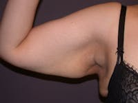 Arm Lift Gallery Before & After Gallery - Patient 252066 - Image 1