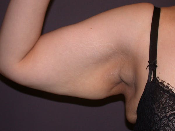 Arm Lift Gallery Before & After Gallery - Patient 252066 - Image 1