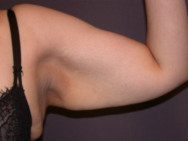 Arm Lift Gallery Before & After Gallery - Patient 252066 - Image 3