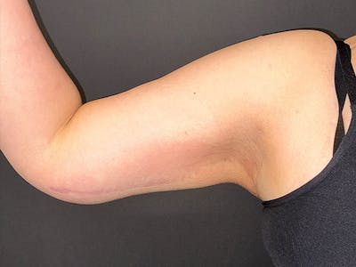 Arm Lift Gallery Before & After Gallery - Patient 252066 - Image 2