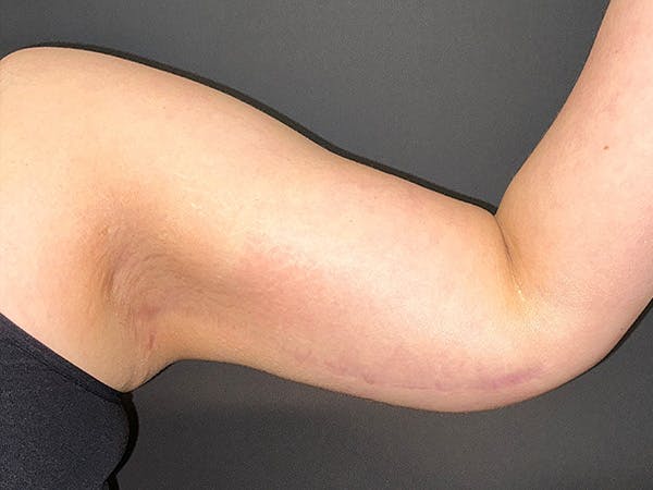 Arm Lift Gallery Before & After Gallery - Patient 252066 - Image 4