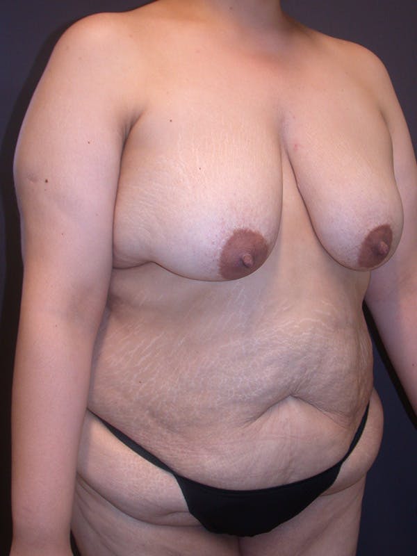 Tummy Tuck Gallery Before & After Gallery - Patient 305789 - Image 3