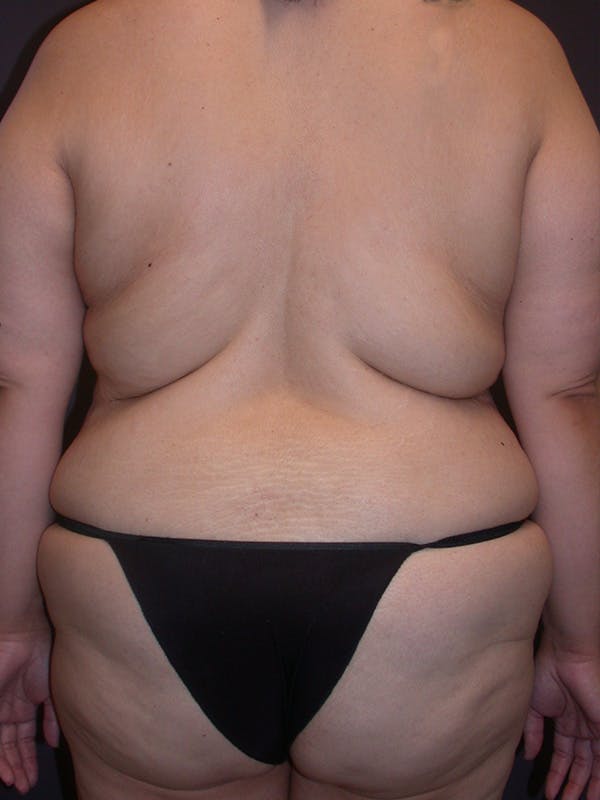 Tummy Tuck Gallery Before & After Gallery - Patient 305789 - Image 5