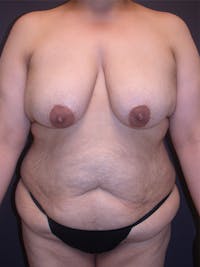 Tummy Tuck Gallery Before & After Gallery - Patient 305789 - Image 1