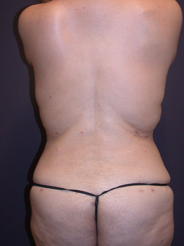 Tummy Tuck Gallery Before & After Gallery - Patient 305789 - Image 6