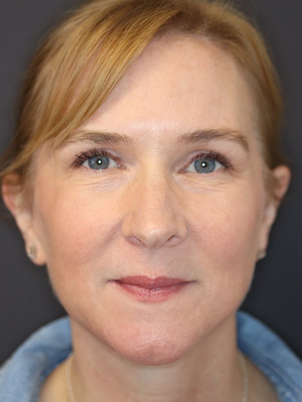 Brow Lift Gallery Before & After Gallery - Patient 211055 - Image 2