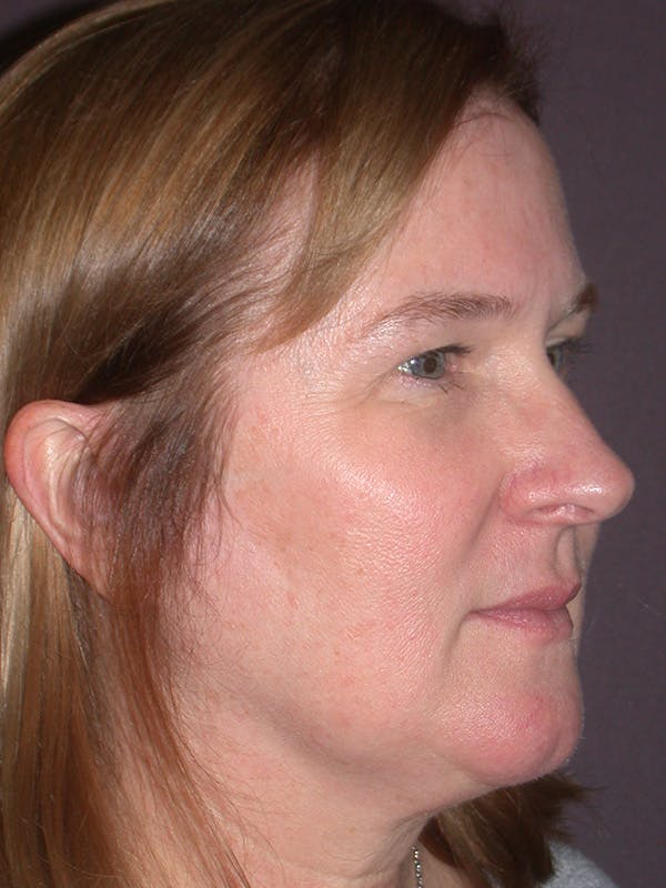 Brow Lift Gallery Before & After Gallery - Patient 211055 - Image 3