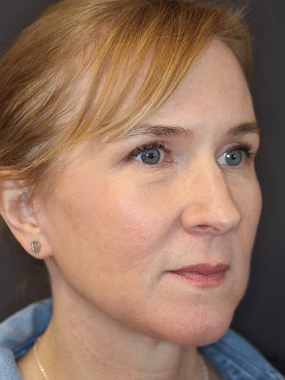 Brow Lift Gallery Before & After Gallery - Patient 211055 - Image 4