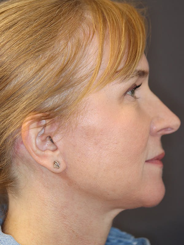 Brow Lift Gallery Before & After Gallery - Patient 211055 - Image 6