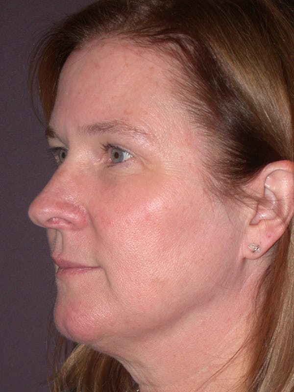 Brow Lift Gallery Before & After Gallery - Patient 211055 - Image 7