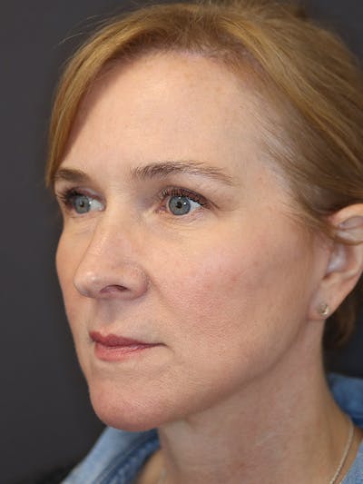 Brow Lift Gallery Before & After Gallery - Patient 211055 - Image 8