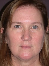 Facelift Gallery Before & After Gallery - Patient 347023 - Image 1