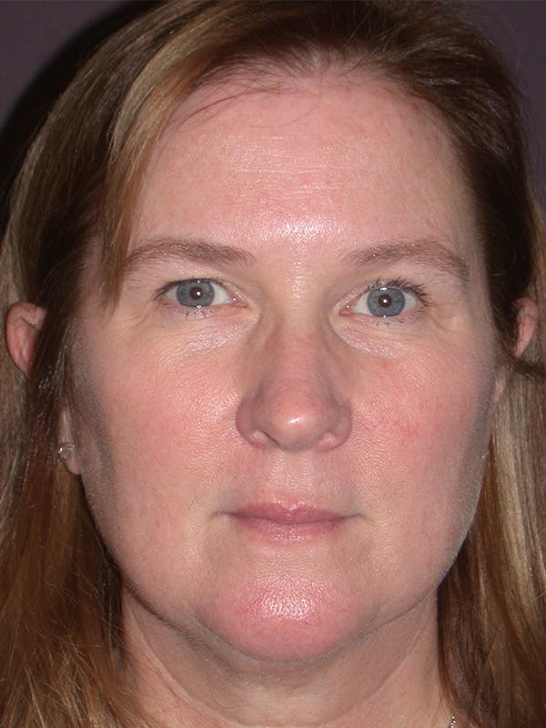 Brow Lift Gallery Before & After Gallery - Patient 211055 - Image 1
