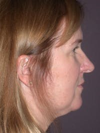 Neck Lift Gallery Before & After Gallery - Patient 295566 - Image 1