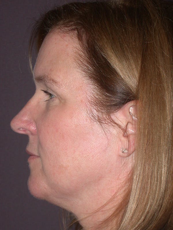 Brow Lift Gallery Before & After Gallery - Patient 211055 - Image 9