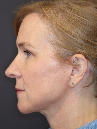 Brow Lift Gallery Before & After Gallery - Patient 211055 - Image 10