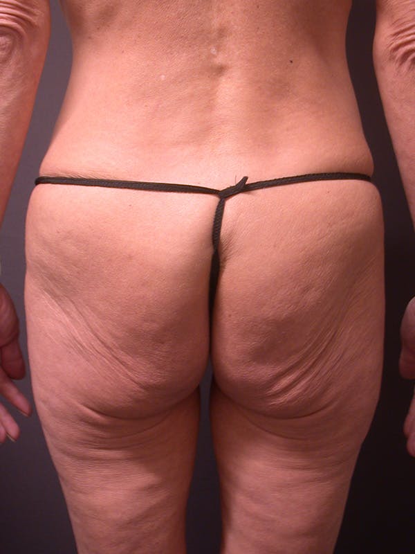 Renuvion Before & After Gallery - Patient 250271 - Image 1
